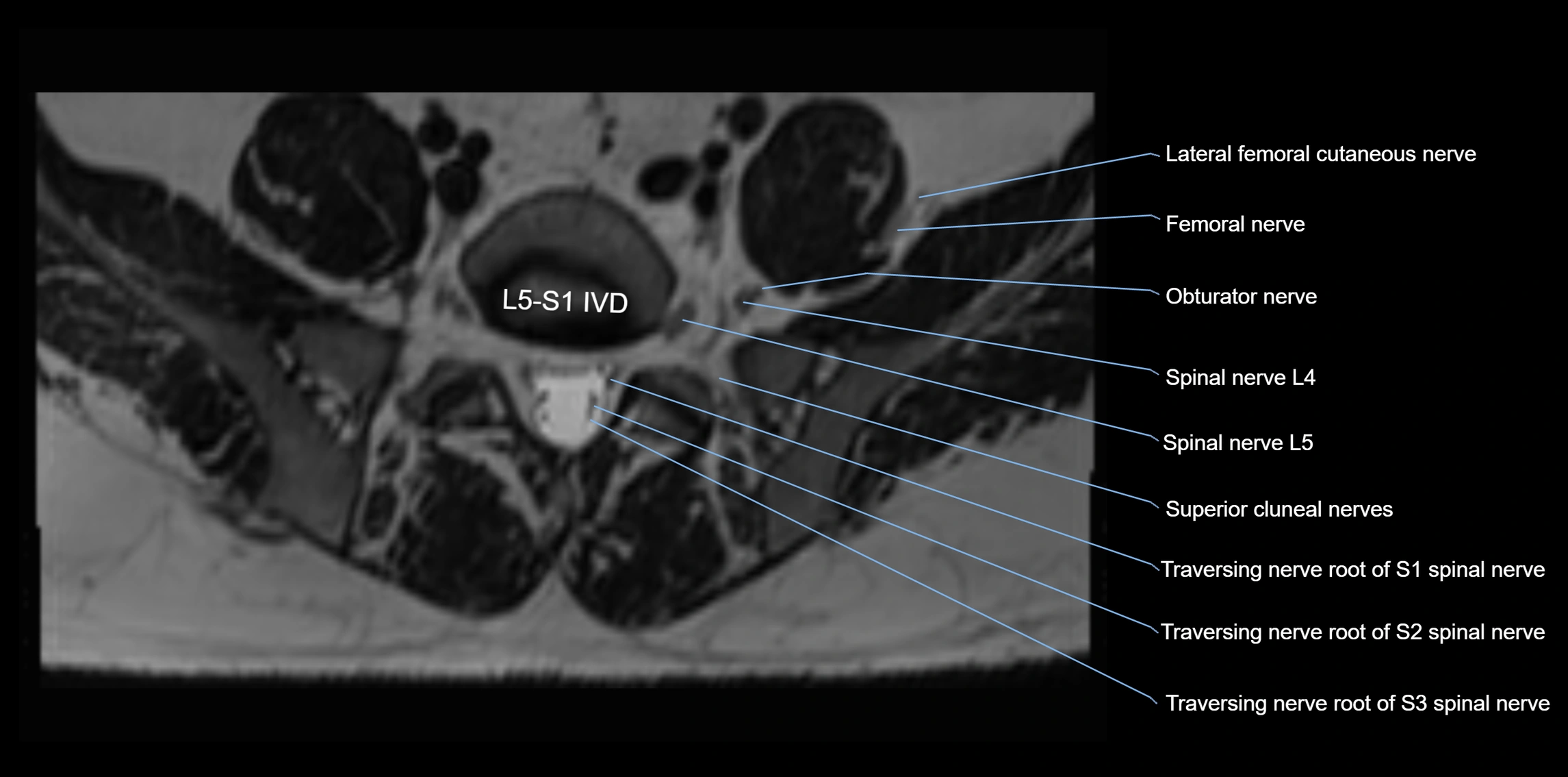 MR lumbosacral plexus axial cross sectional anatomy 3T  radiology  image-img-1008001-00062.webp